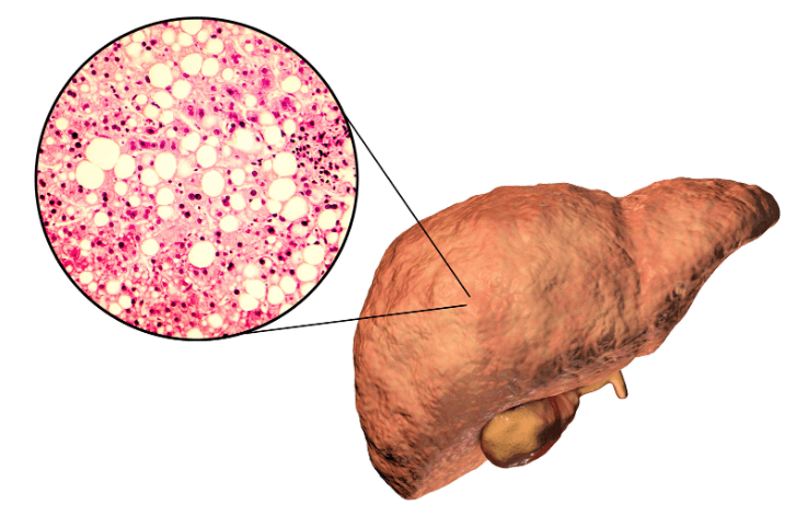 Is There a Quick Way to Reverse Fatty Liver?