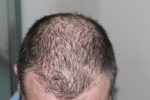 Male Pattern Baldness: Causes, Treatments, and Prevention Tips